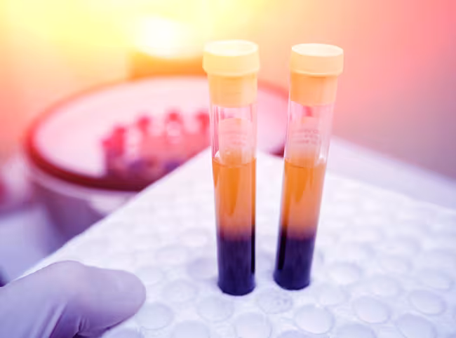 PROADI-SUS apoia a Anvisa na consolidação de Marco Regulatório sobre Plasma Rico em Plaquetas